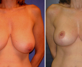 Dr. Snyder - Breast Lift / Reduction