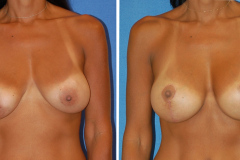 Dr. Snyder - Breast Lift with Implants