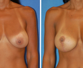 Dr. Snyder - Breast Lift with Implants